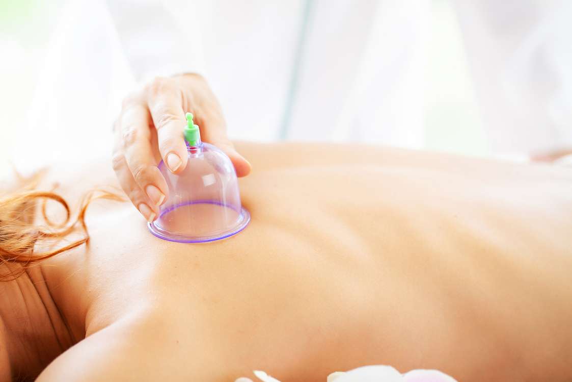 Cupping behandling hos Sund med Helle